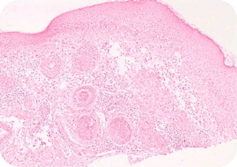 Rosacea Types, Triggers, & Treatment Options