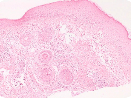 Rosacea Types, Triggers, & Treatment Options