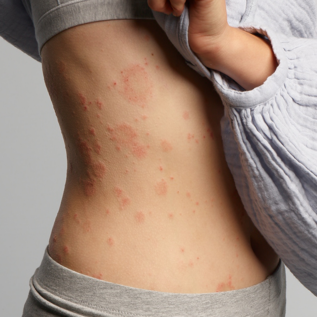 Eczemact Body Care Set