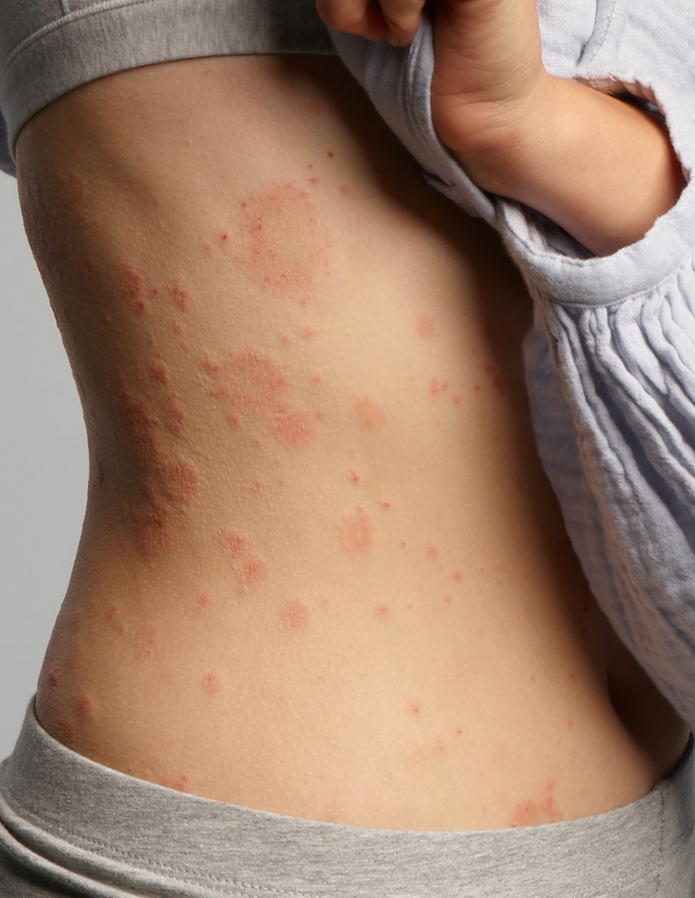 Eczemact Body Care Set Eczemact Body Care Set