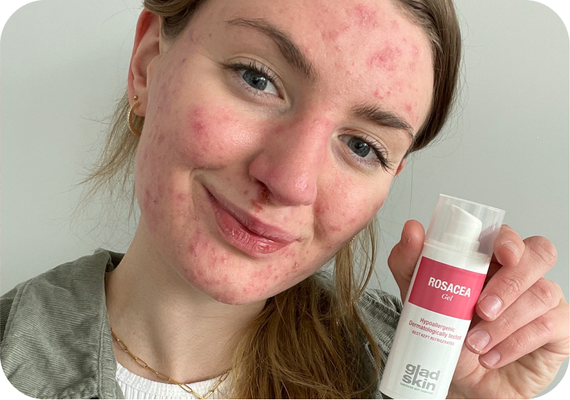 SKIN JOURNEY: Mina’s shares her experience with Acne and Rosacea