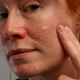 Rosacea Gel Moisturizing Set